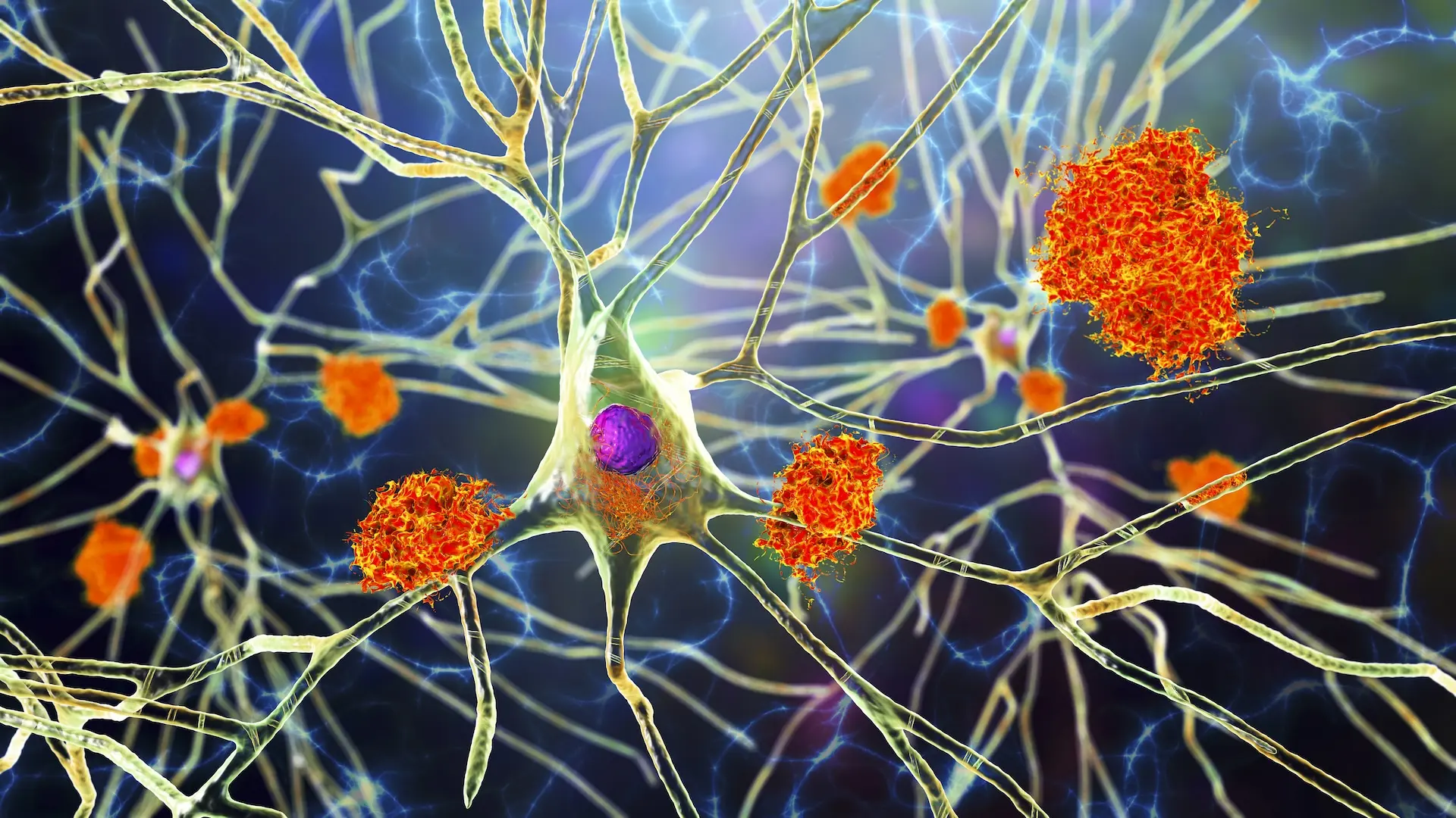 Alzheimer Teşhisinde Devrim Niteliğinde Gelişme: İlk Kan Testi Ortaya Çıktı!