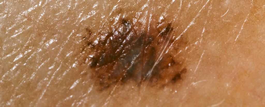 Kanser Tedavisinde Devrim! Genetiği Değiştirilmiş Herpes Virüsü Melanomu Küçültüyor