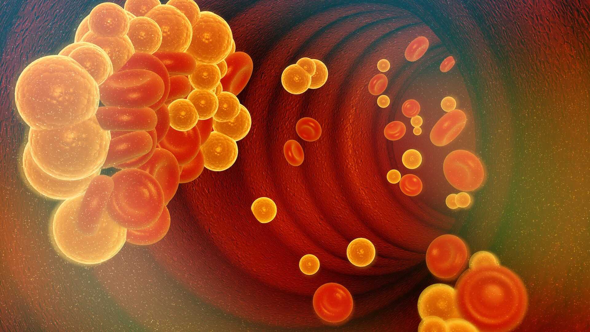 Kötü Kolesterol Kâbusu Sona Eriyor mu? DNA Düzenleyen Tedavi Umut Saçıyor!