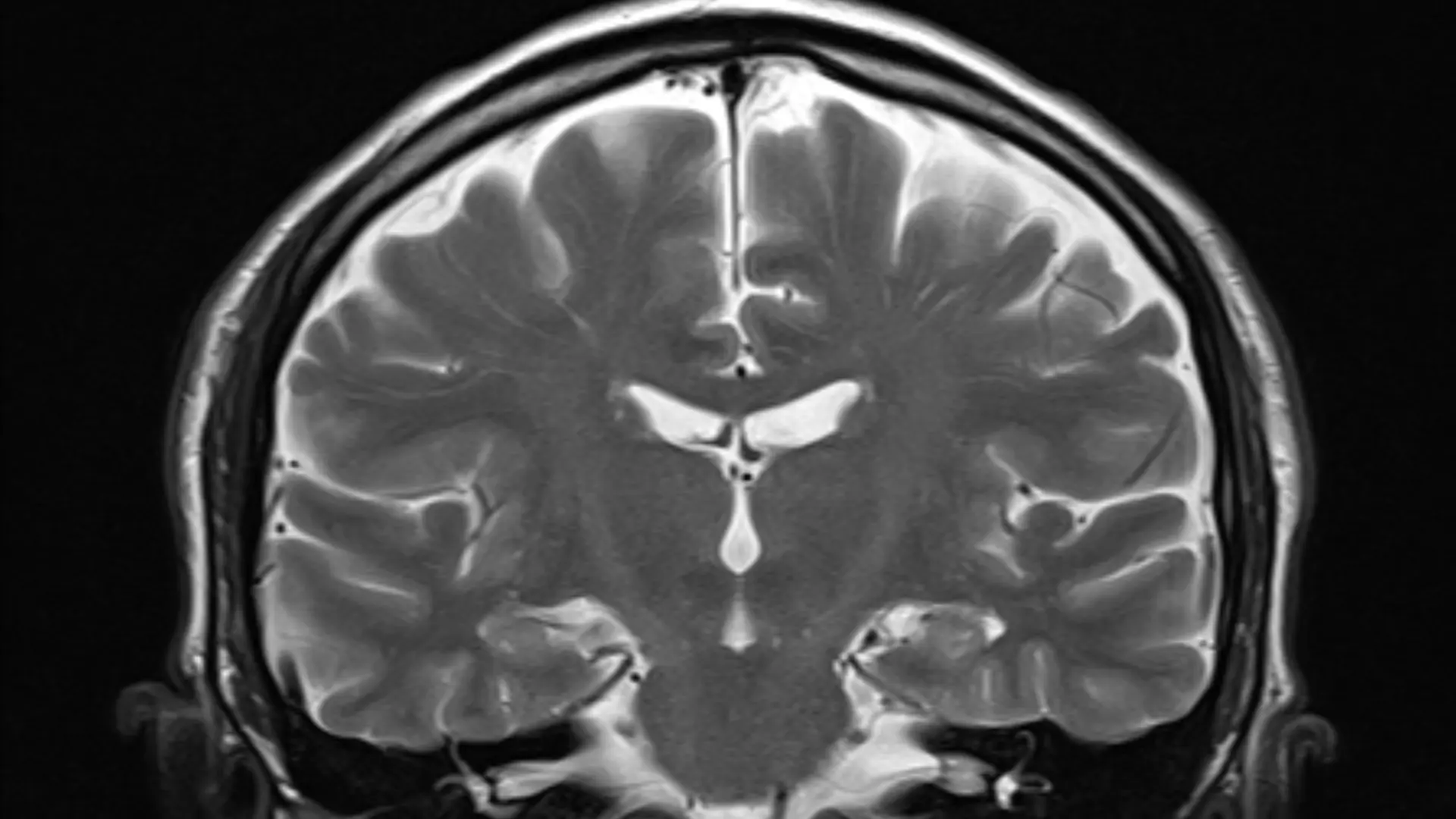 Beyninizin Tek Bir MRI'ı Yaşlanma Hızınızı Ortaya Koyuyor: Bilim İnsanları Açıklıyor