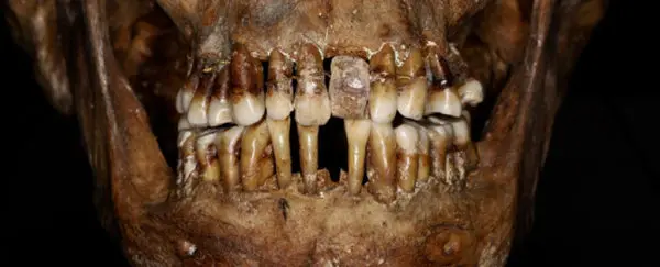 400 Yıllık Sır Ortaya Çıktı: 17. Yüzyıl Aristokratının Dişleri İçin Altın Tel Kullanımı