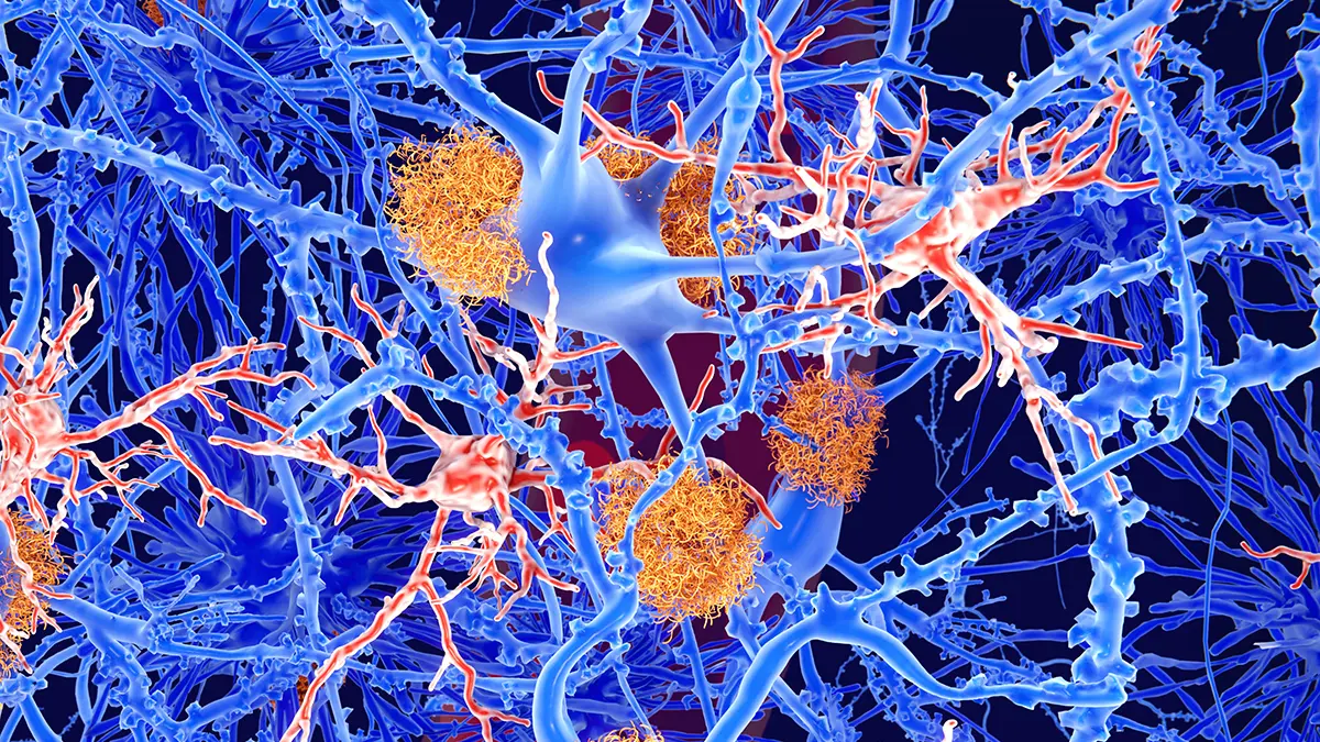 Alzheimer Tedavisindeki Umut Veren Yöntem Beklenen İlacı Göstermedi