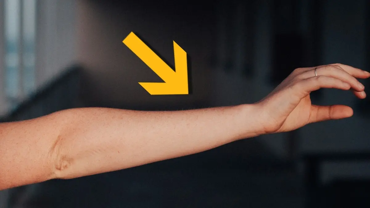 İnsan Kolunda Ortaya Çıkan Yeni Damar: Evrimimizin Sürdüğüne Dair İşaret mi?