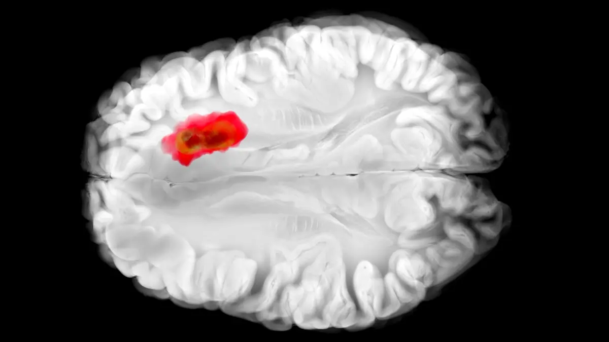 Yaygın Bir İlaç, Ölümcül Beyin Kanserleriyle Savaşabilir mi? Yeni Araştırma Umut Veriyor