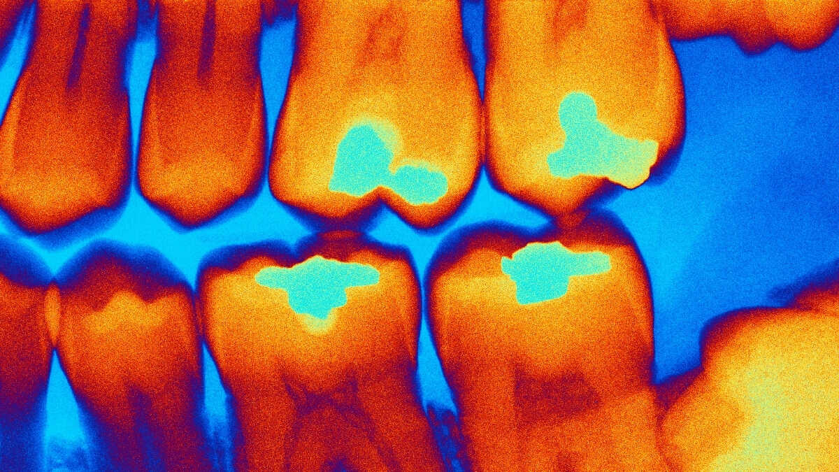 Diş Dolgularında Cıva Dönemi Sona Eriyor: 2034'e Kadar Yasaklanacak