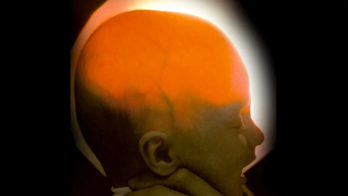 Beyninin Çoğu Olmadan Doğan Kadın 20 Yaşına Bastı: Tıbbi İmkansızlıkları Yeniden Yazdı