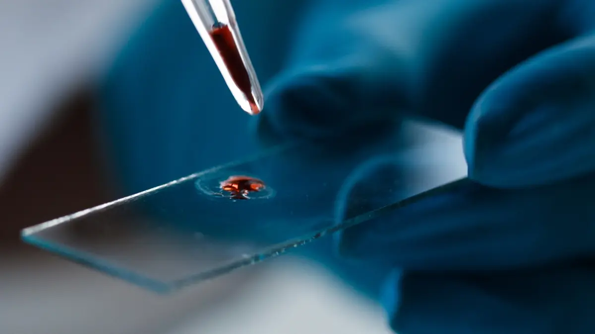 Kan Testiyle Alzheimer Belirtileri Yıllar Önceden Tahmin Edilebilecek!