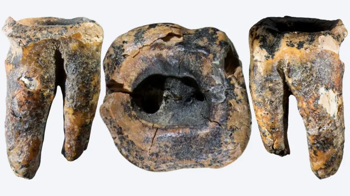 Diş Ağrısına 60 Bin Yıllık Şifa: Neandertaller'den Şaşırtan Cerrahi Girişim