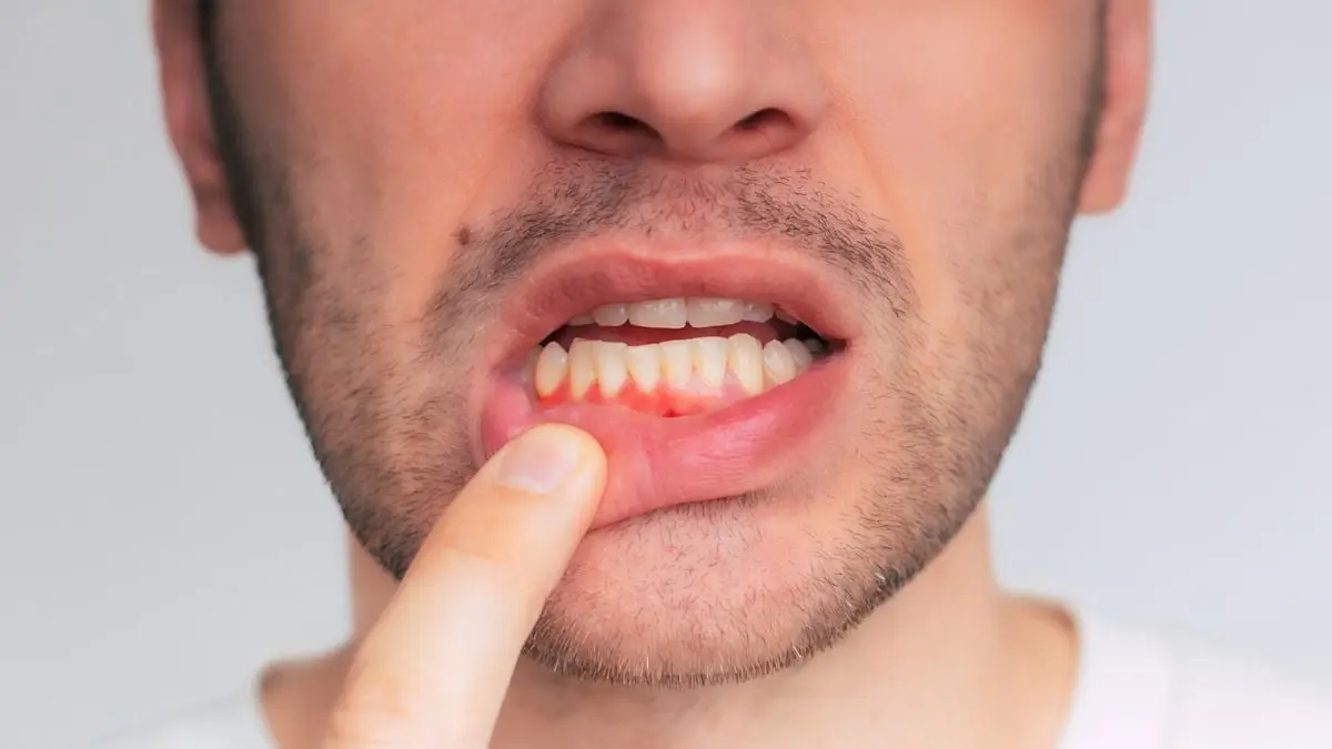 Diş Eti Sağlığını Yeniden Tanımlayan Yenilikçi Gummy'ler: Sadece 6 Haftada Etkili Sonuçlar!