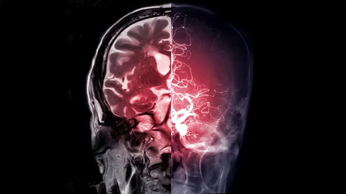 Evrim Mekanizması Alzheimer Riskini Sessizce Azaltıyor Olabilir mi?